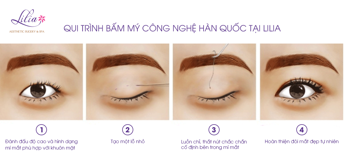 Bấm mí Hàn Quốc