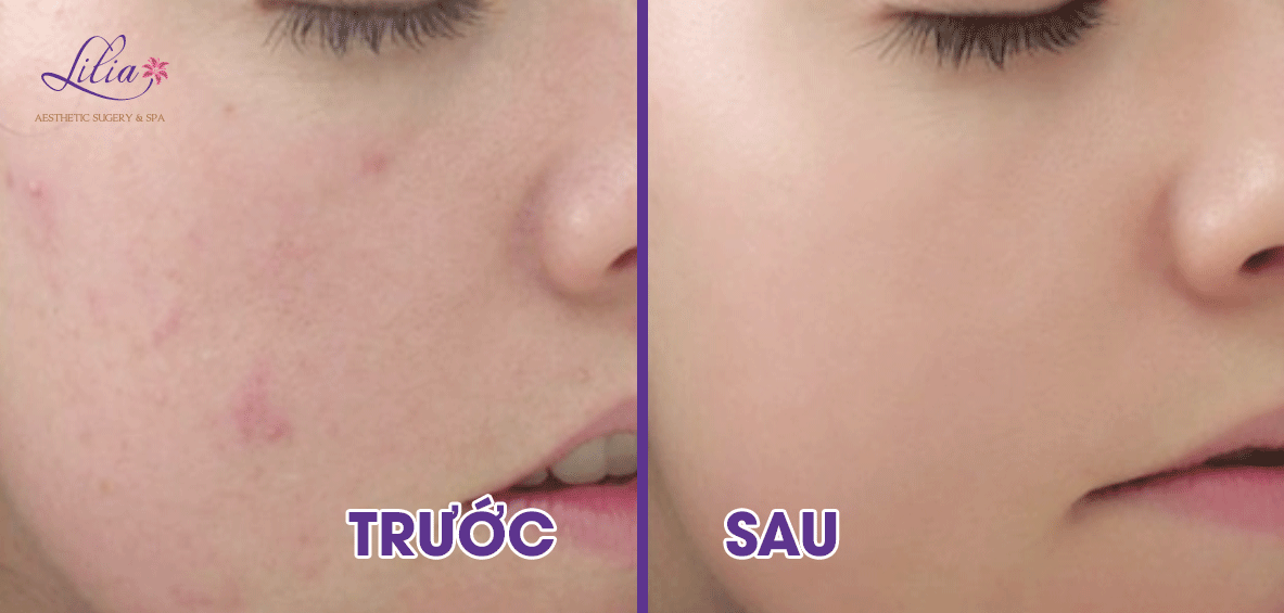 3 Trị mụn tận gốc