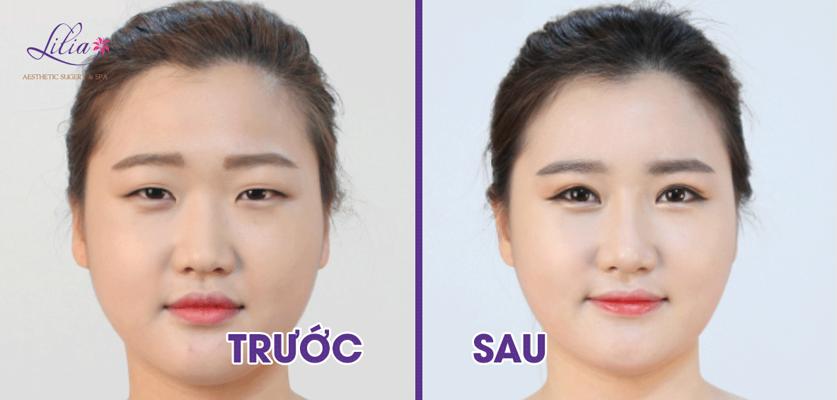 Bấm mí Hàn Quốc