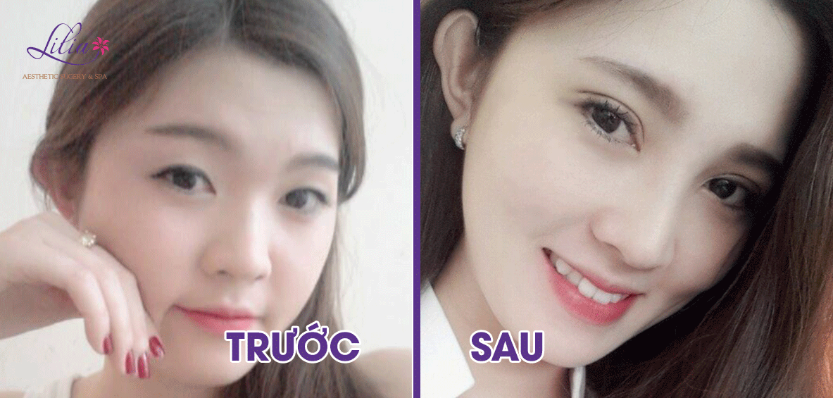 Bấm mí Hàn Quốc