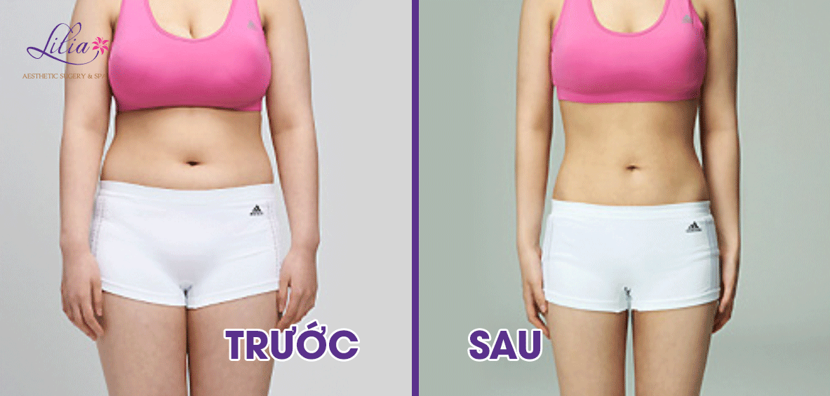 giảm béo siêu tốc RF Calivipo