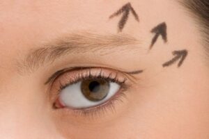Cắt mí Hàn Quốc – Cách làm mắt to, đẹp hút hồn như sao Hàn