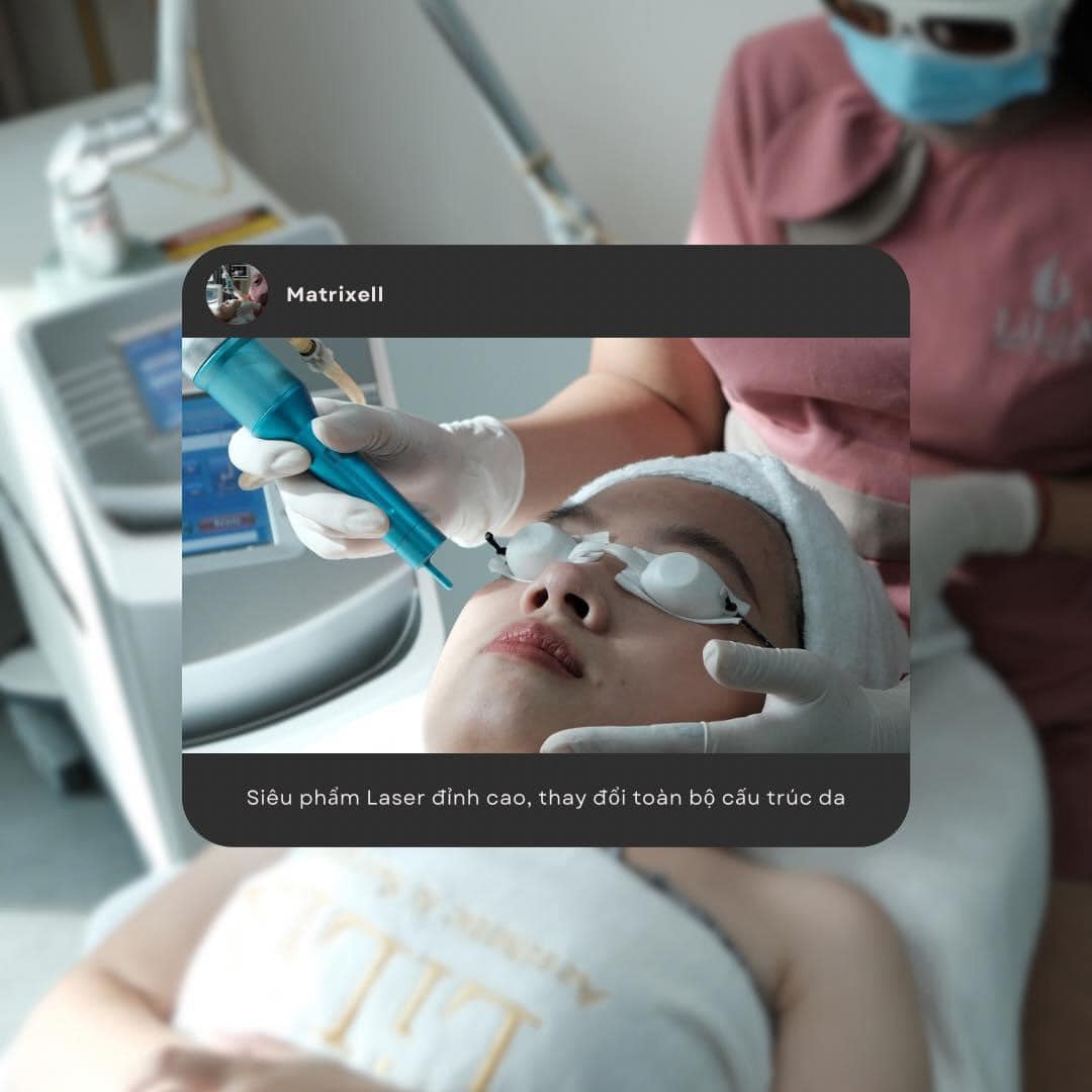 Trị nám, tàn nhang với công nghệ Matrixell
