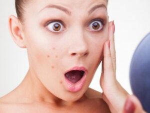 Điều trị mụn ở đâu hiệu quả nhất tại Hà Nội