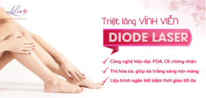 Giá triệt lông vĩnh viễn bằng công nghệ Diode Laser