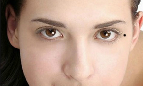 Tẩy Nốt Ruồi Có Đau Không