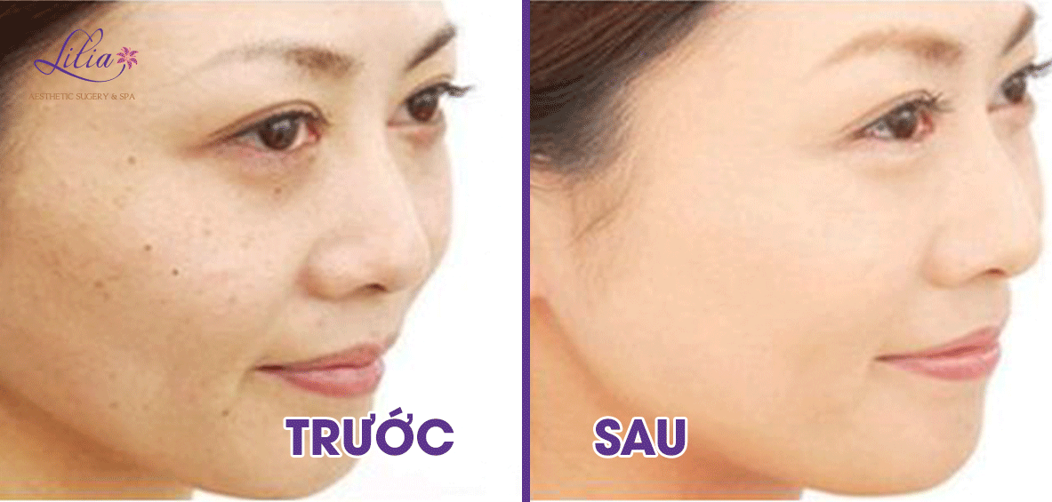 Điều trị da giãn mao mạch công nghệ E-light