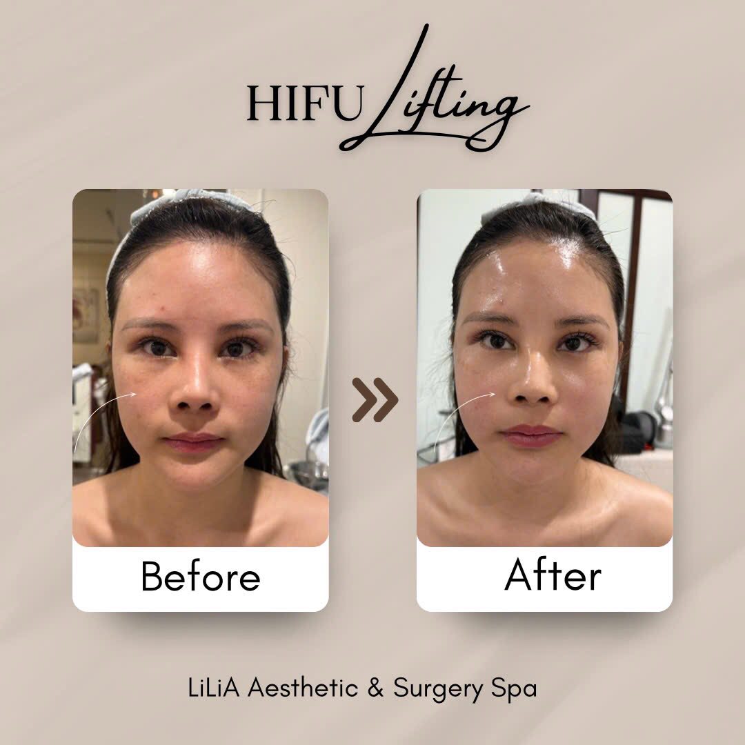 Cải thiện hố lê hiệu quả bằng Hifu Lifting