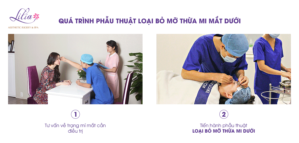 lấy mỡ thừa mí mắt dưới