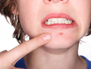 Trị mụn bọc ở đâu tốt nhất hiện nay?