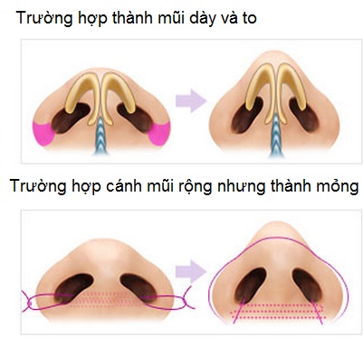 Giải đáp thắc mắc : Cắt cánh mũi ở đâu đẹp và an toàn?