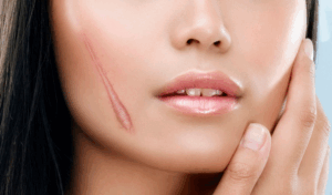 Sẹo lồi lâu năm – làm sao để hết