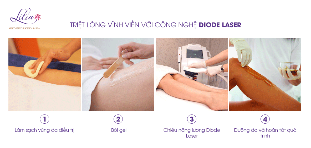 Triệt lông tay vĩnh viễn giá bao nhiêu