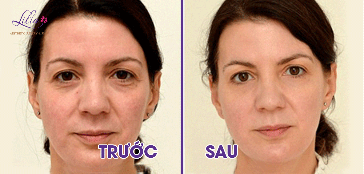 Trẻ hoá da công nghệ Laser