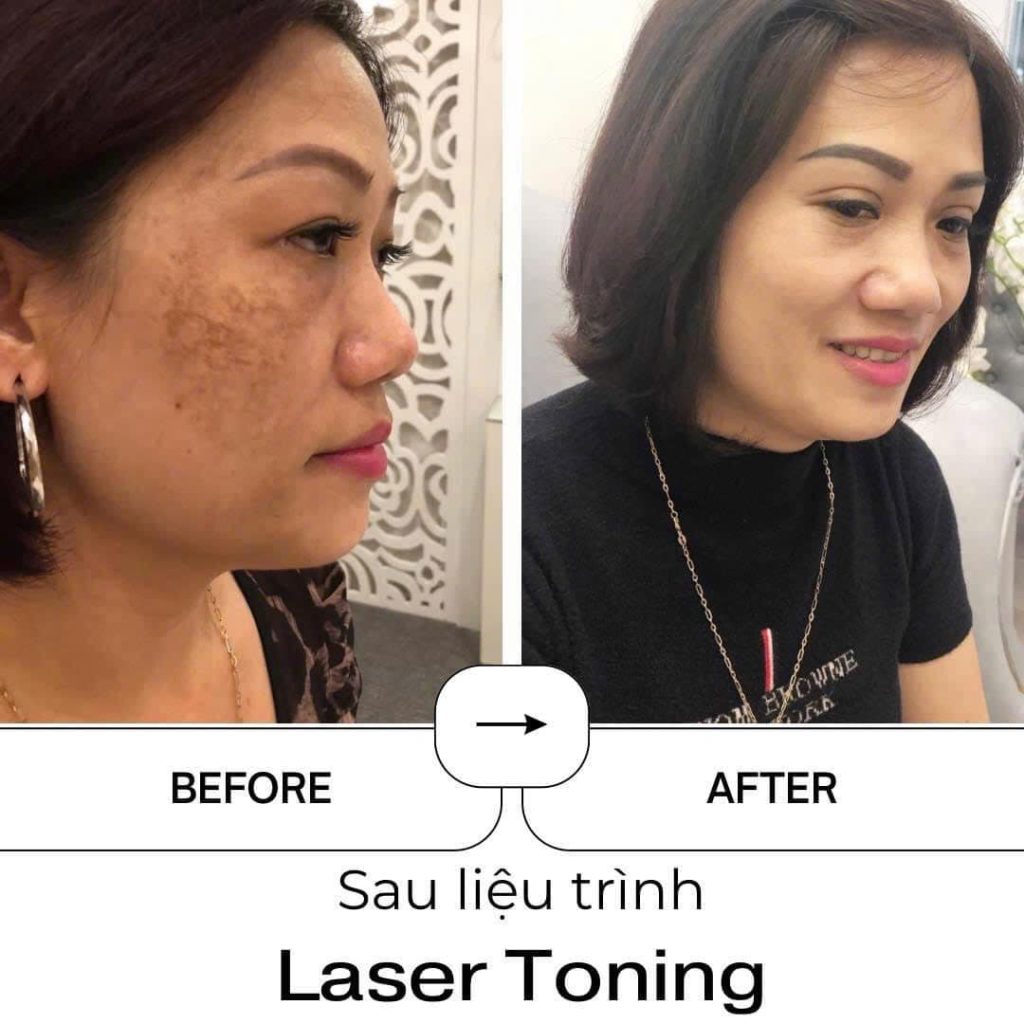 Hình ảnh hiệu quả điều trị nám tàn nhang Laser Toning
