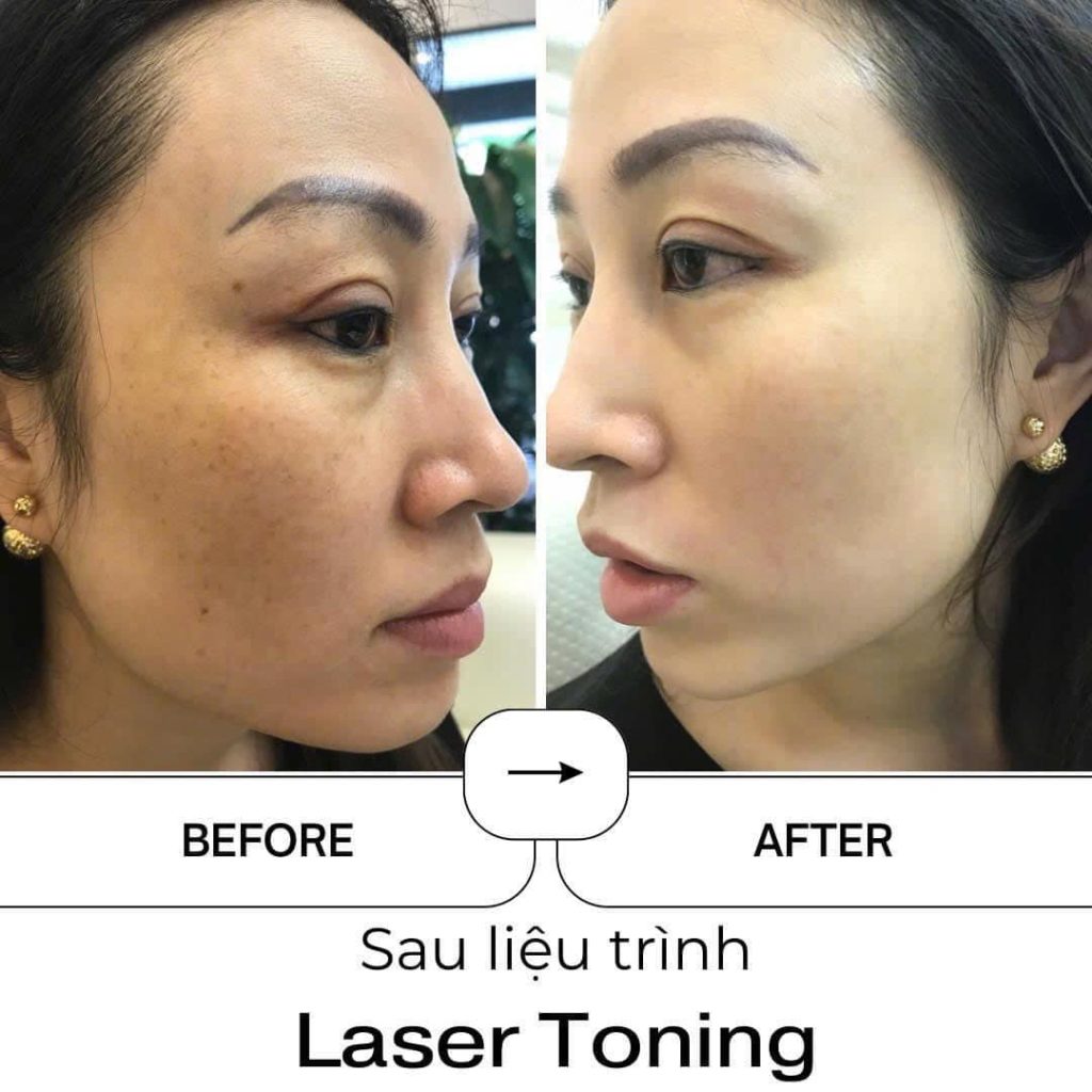 Trị nám tàn nhang công nghệ Laser Toning có hiệu quả không