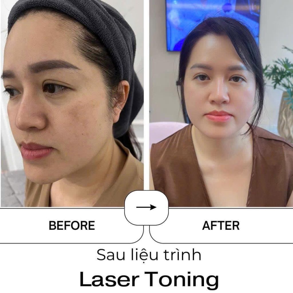 Hiệu quả trị nám tàn nhang công nghệ Laser Toning tại Thẩm mỹ viện LiliA