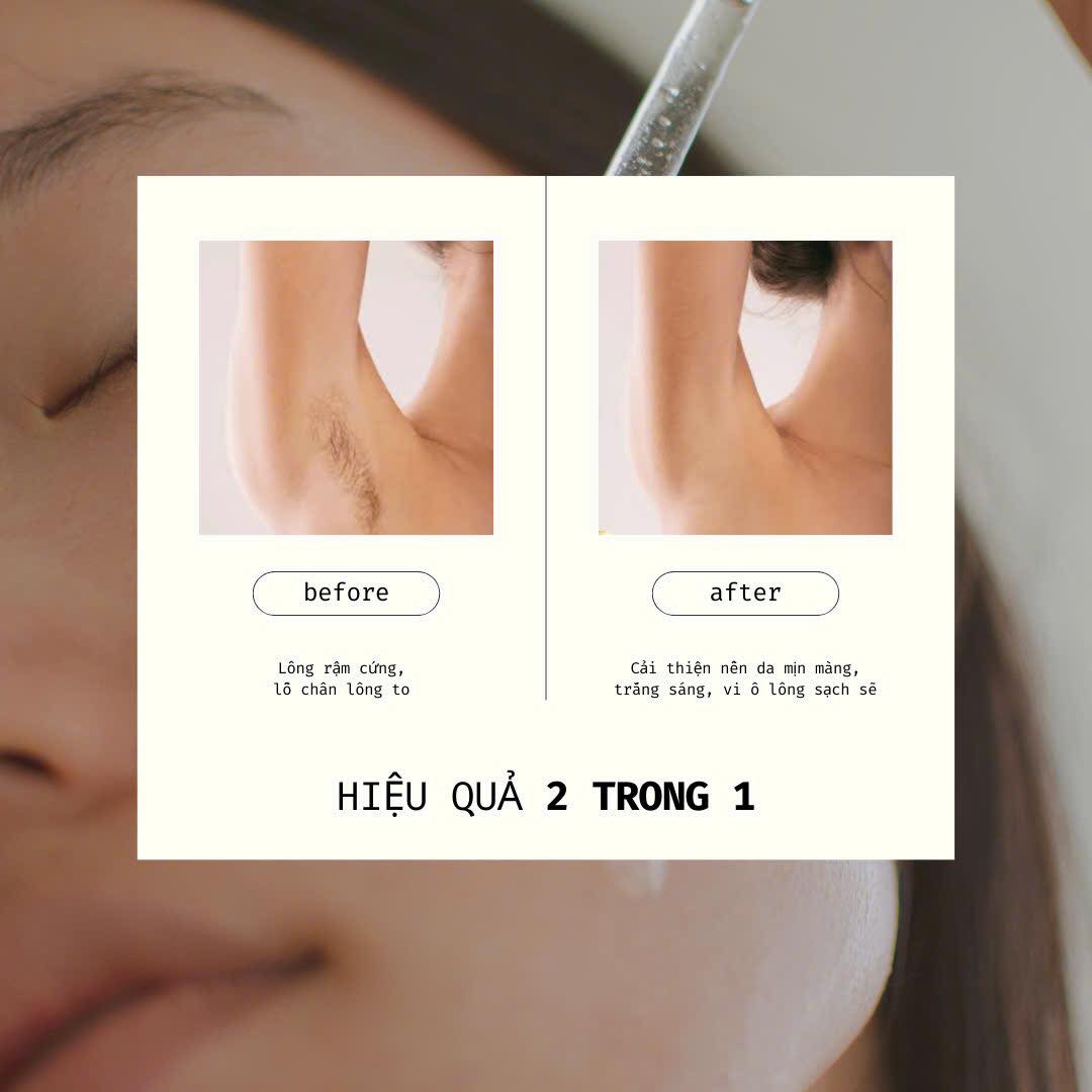 Hiệu qủa triệt lông vĩnh viễn công nghệ DPL tại Thẩm mỹ viện LiliA