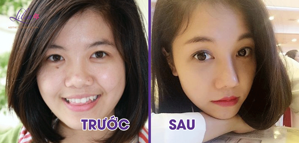 Phẫu thuật hố lê