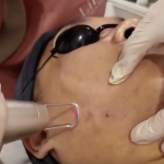 Trị thâm mụn với Laser Toning tại LiliA