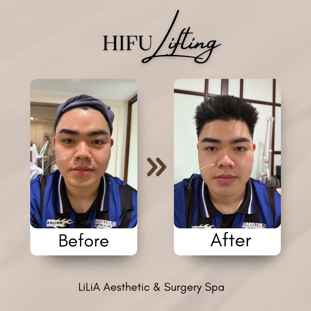 hieu-qua-hifu-3