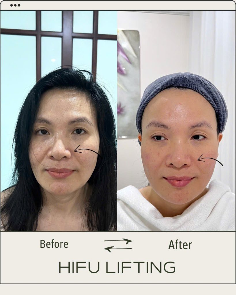 Chi phí làm hifu và hiệu quả thực tế của Hifu tại Thẩm mỹ viện LiliA