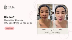 Hifu là gì? Tìm hiểu cơ chế tác động