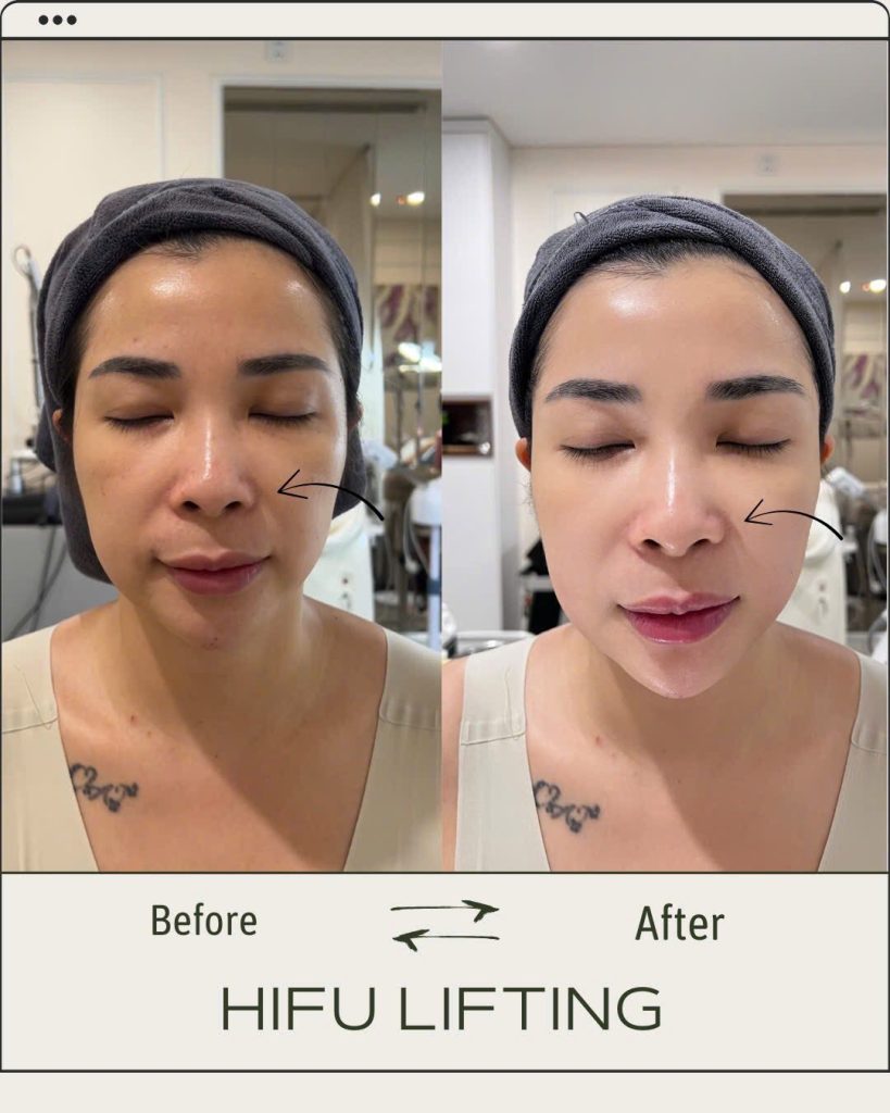 Trẻ hoá da mặt Hifu lifting 
